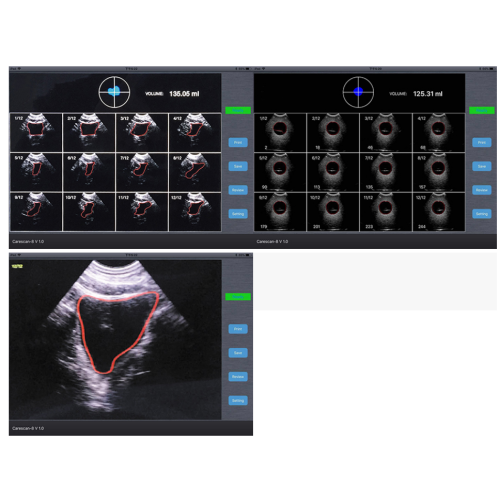 Scanner à ultrasons de la vessie sans fil